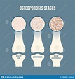 Osteoporosis Stages. Aging Process With Bone Cartoon Vector ...
