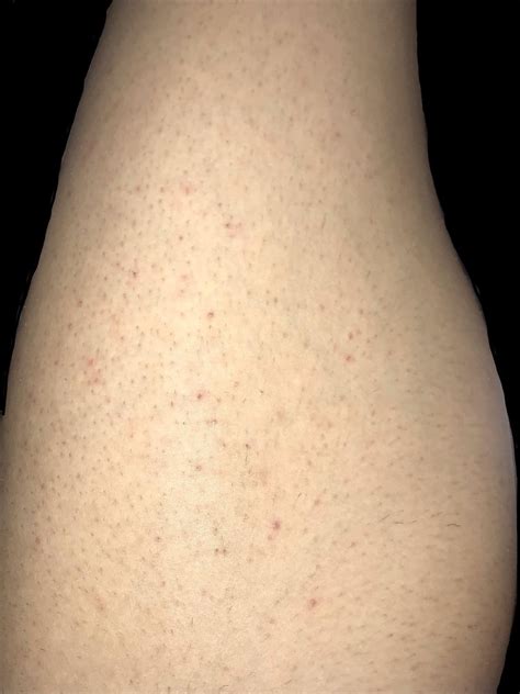 Im Having Problems With Red Spots All Over My Legs And Bum After