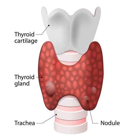 Thyroid Nodules Ethanol Ablation Of Benign Thyroid Cysts Another