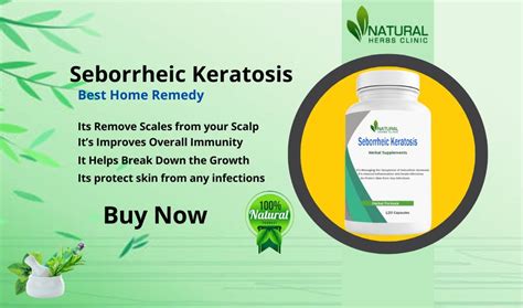 Seborrheic Keratosis And How To Treat It With Natural Remedies