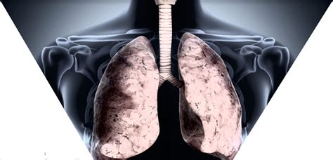 Tratamiento Natural Para Mejorar La Fibrosis Pulmonar Consalud Info