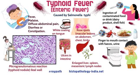 Pathology Of Typhoid Fever Dr Sampurna Roy MD