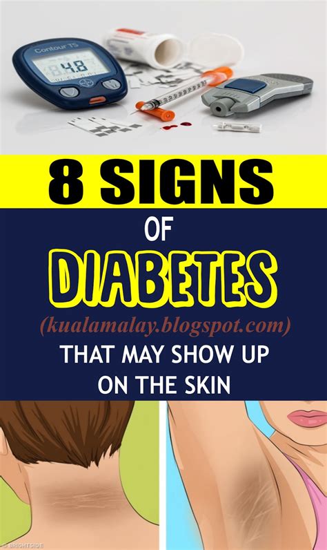8 Signs Of Diabetes That May Show Up On The Skin Health And Wellness