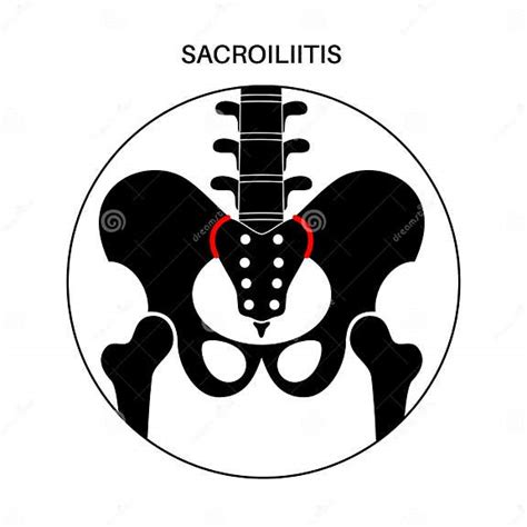 Sacroiliitis Medical Poster Stock Vector Illustration Of Arthritis
