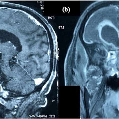 Contrast Enhanced Mri Scan Of A Patient With Cerebral Involvement