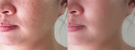 Before And After Spot Melasma Treatment Stock Photo Image Of Melasma