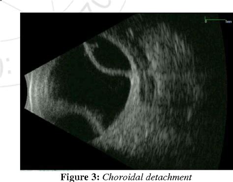 Figure 1 From A Study Of Role Of B Scan Ultrasound In Posterior Segment