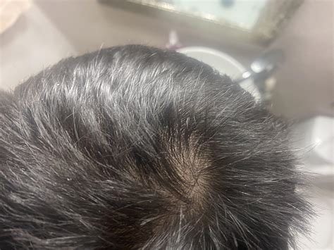 Early Balding Signs