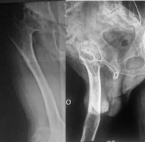 Ap And Lateral Radiographs Of The Right Hip With Thigh Showing The