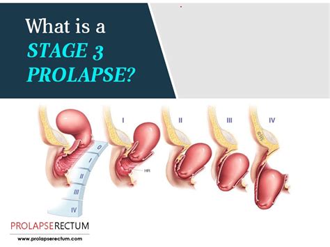 What Is A Stage 3 Prolapse In 2020 Rectal Prolapse Rectal Herbal Treatment
