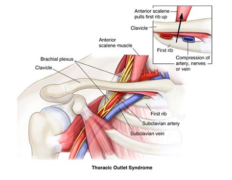 Thoracic Outlet Syndrome Physiofix