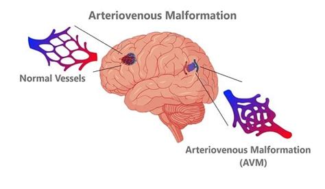 Arteriovenous Malformation Avm Yashfiin Health