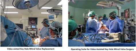 Video Assisted Key Hole Mitral Valve Procedure Cardiac Surgery Online