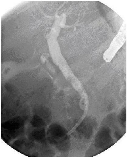 Ercp Shows Several Filling Defects Within A Prominent Cbd Suggestive