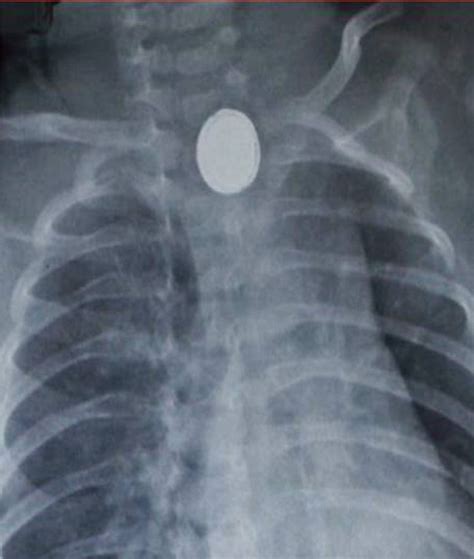Chest X Ray Showing Radiopaque Foreign Body With Characteristic Halo