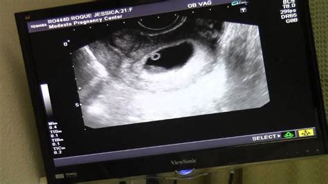 8 Week Ultrasound Baby 4 Youtube