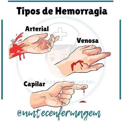 Dr Albertomeza Tipos De Hemorragia
