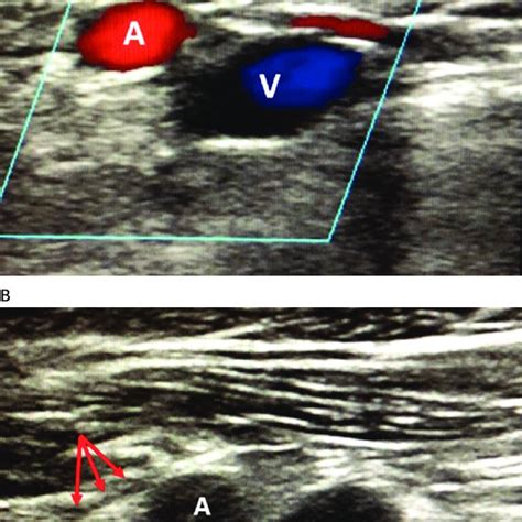 Ultrasound Imaging Of The Axillary Artery In Relation To The Axillary