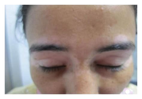 Patient Of Vitiligo Treated With Nbuvb Phototherapy Showing Diffuse