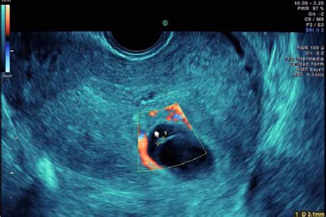 Visión De Saco Gestacional Y Embrión En Cuerno Uterino Izquierdo Se