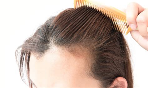The Truth Behind Female Pattern Hair Loss West La Hair Restoration