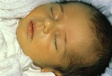 Neonatal Or Newborn Jaundice Symptoms Causes Risks And Treatment