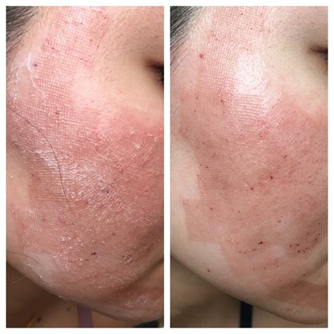 Fractional Co2 Laser Before After 2 Sessions — Beautypeadia