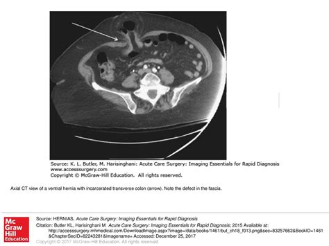 Axial Ct View Of A Ventral Hernia With Incarcerated Transverse Colon