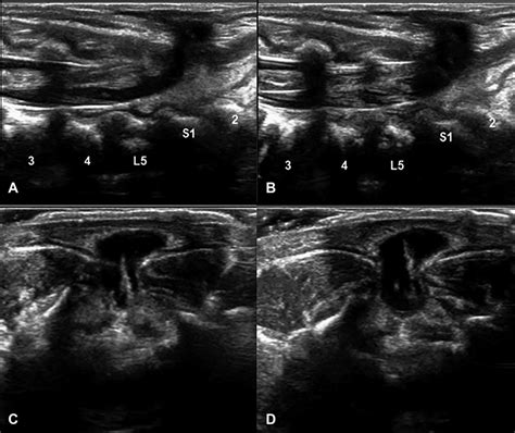 Myelocele Sagittal Ab And Axial Cd Ultrasound Images Show An