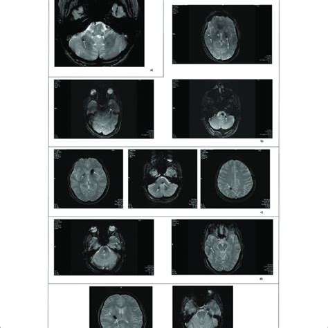 Mri Scan Of Patients Mri Images Obtained By T2 Weighted Gradient