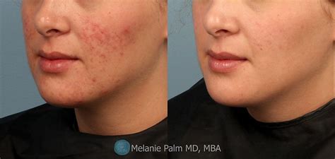 Acne Scars Before And After Pin On Acne Scars Overnight View Some Of