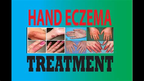 Dyshidrotic Eczema Dyshidrosis Symptoms Causes Treatm