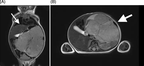 A B Abdominal Magnetic Resonance Image Of An Immature Teratoma