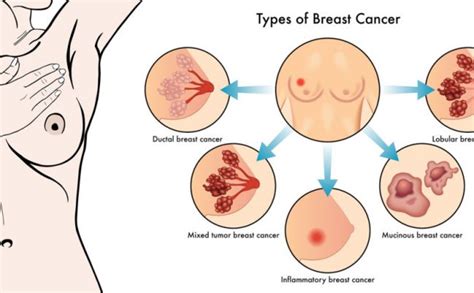 The common symptoms are the following. 3 Cara Ini bisa Bantu Deteksi Dini Kanker Payudara ...
