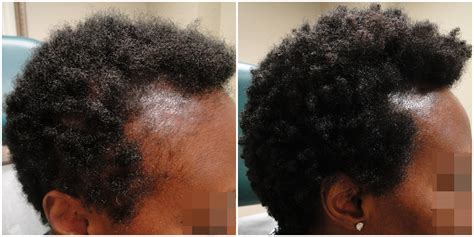 Hair loss is an issue that has been the bane of men and women forever. PRP for hair loss - Dr MediSpa
