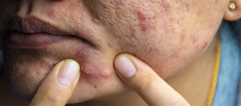 Cystic Acne Treatment Pimple Under The Skin Reequil