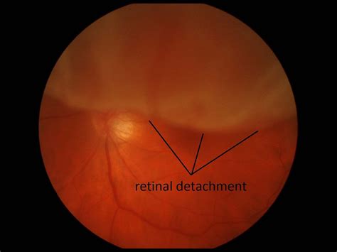 Retinal Detachment Treatment In Elmhurst Il Skowron Eye Care
