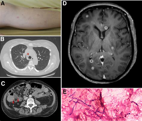 Disseminated Nocardiosis A Subcutaneous Nodules Of The Lower