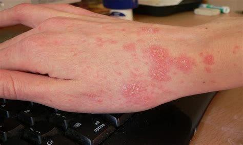 What Does Scabies Look Like