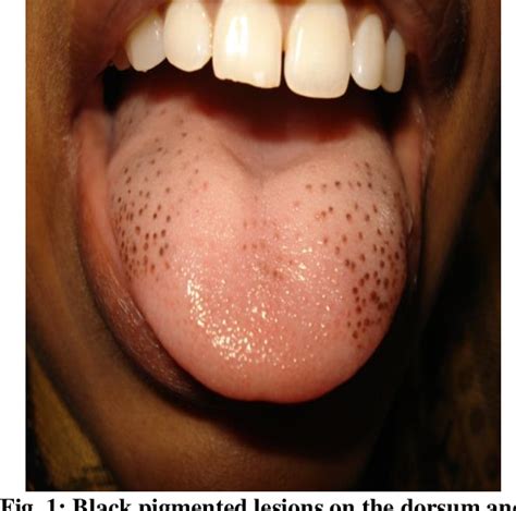 Pigmentation Of The Funorm Papillae Of The Tongue In A Child
