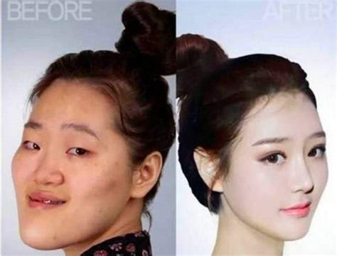 19 Mind Blowing Before And After Faces From South Koreas Plastic