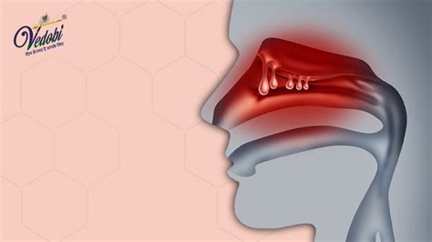 Vedobi Nasal Polyps Symptoms Causes And Treatment