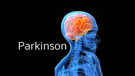 Parkinson Leicht Erklärt Einfach Erklärt Youtube