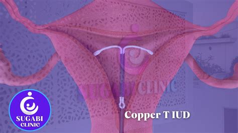 Copper T Iud A Safe Effective And Long Acting Contraceptive Option Sugabi Clinic Patient
