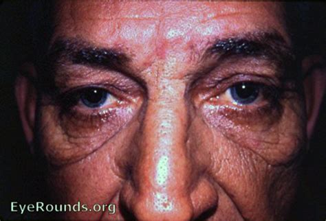 Groenblad Stranberg Syndrome Pseudoxanthoma Elastcum With Andioid