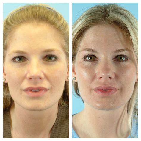 Cheek And Jaw Filler Before And After