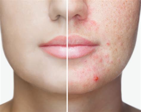 People With Acne Prone Skin Can Find Relief With Dr Jeffrey Ross