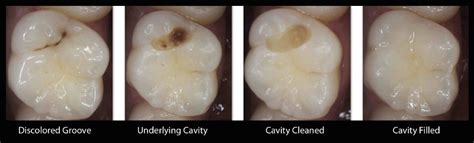 Tooth decay destroys the hard enamel and dentin of your teeth, exposing the nerves and leading to sensitive teeth and toothaches. Regular Dental Visits Are Important... | Dr. Nechupadam ...