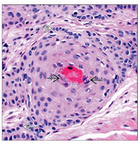 Tumor Of The Follicular Infundibulum Basicmedical Key