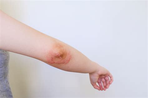 Atopic Dermatitis On Women Hand Elbow Joint Eczema Allergies Skin
